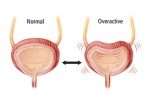 Overactive Bladder, Overactive Bladder signs, here are some warning signs of an overactive bladder, Overactive bladder