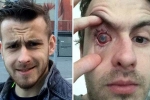 contact lens safety, contact lens safety, contact lens wearers beware man goes blind after parasites eat man s eye as he wore lenses in shower, Sleepless nights