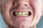 Nicotine stains good for health, Nicotine stains research, are nicotine stains on your teeth irreversible, Teeth