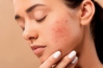 pimples, dermatologist, 10 ways to get rid of pimples at home, Dermatologist